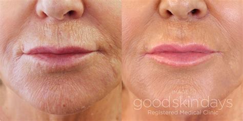 juvederm volite before and after.